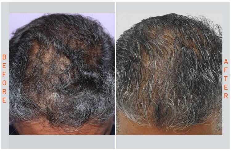 GFC Hair Treatment, gfc  before after photos in mumbai india 